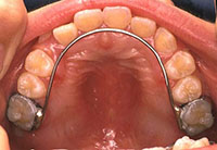 リンガルアーチ