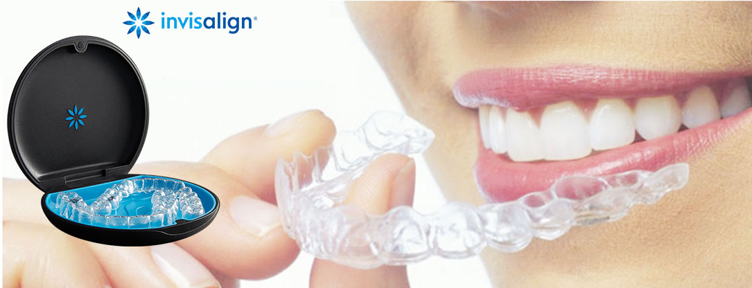 インビザライン