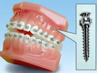 矯正用アンカースクリュー矯正